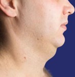 Fotografía del área de la papada tratada antes del procedimiento de liposucción