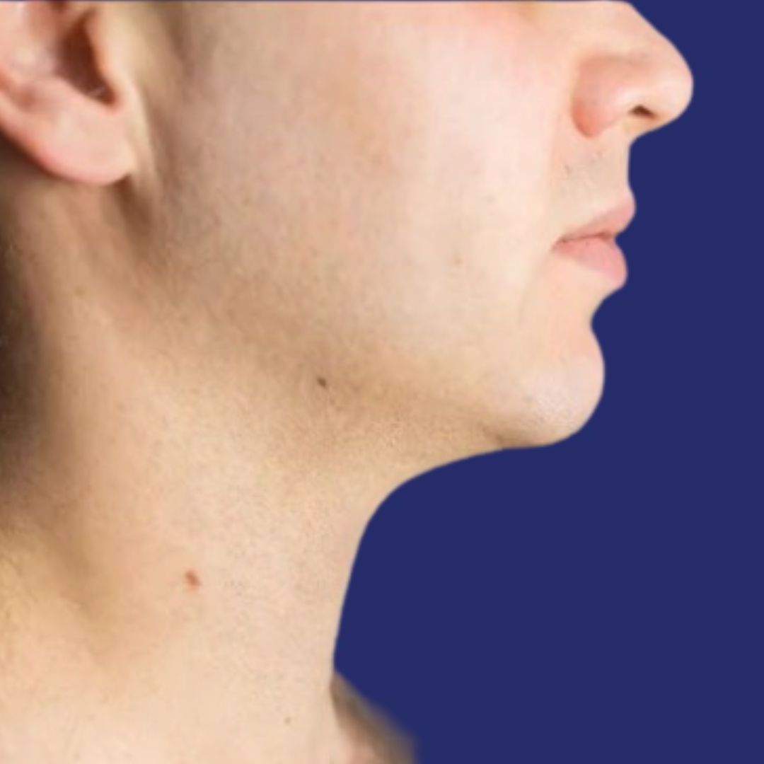 Fotografía del área de la papada tratada después del procedimiento de liposucción
