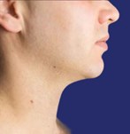 Fotografía del área de la papada tratada después del procedimiento de liposucción