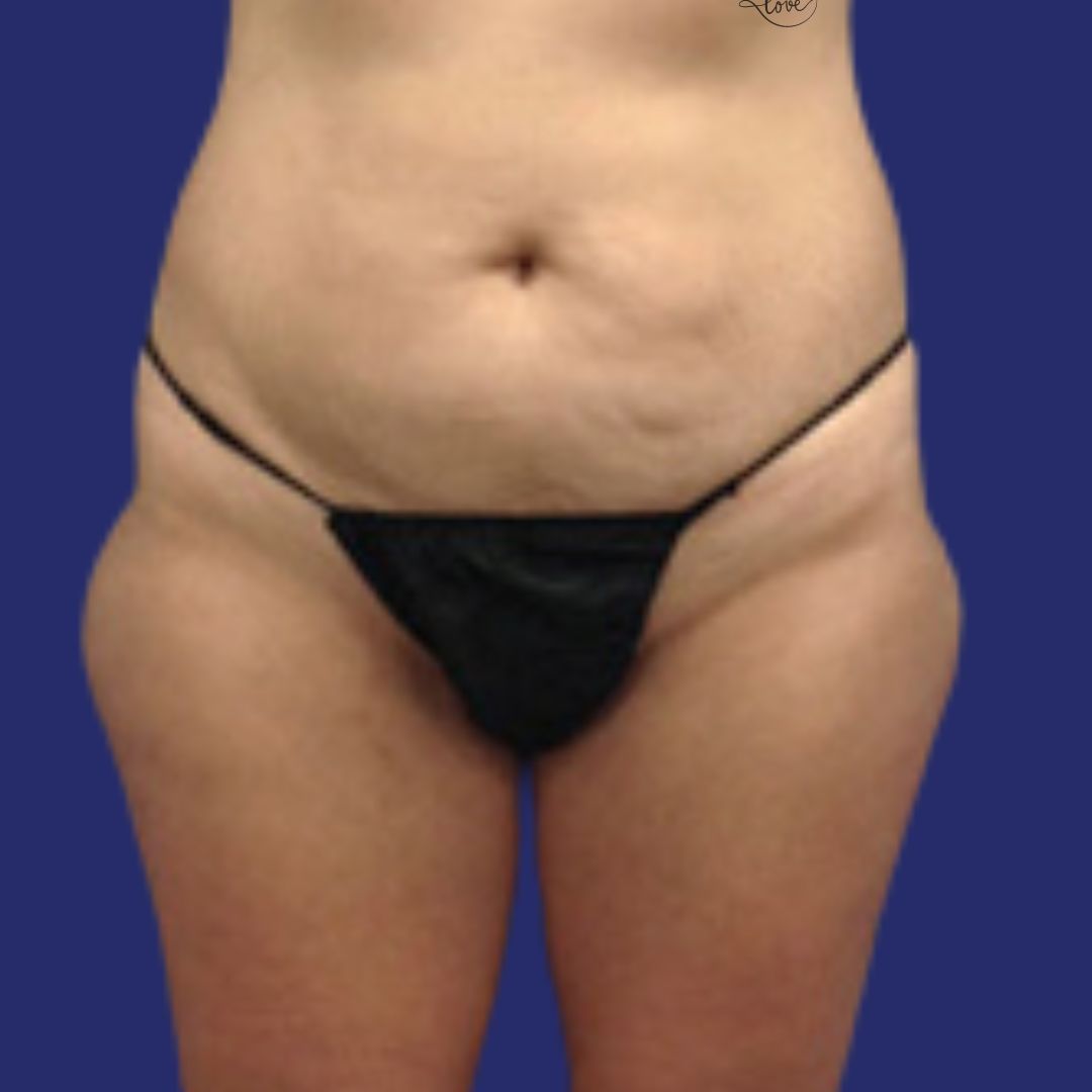 Liposuction saddlebags - before