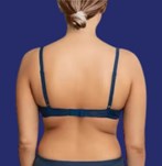 Before liposuction on a woman's back