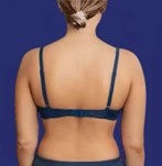 After liposuction on a woman's back