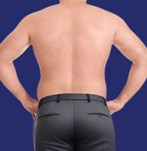 liposucción cartucheas espalda hombre antes