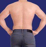 foto liposucción cartucheas espalda hombre después