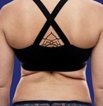 foto antes liposucción espalda