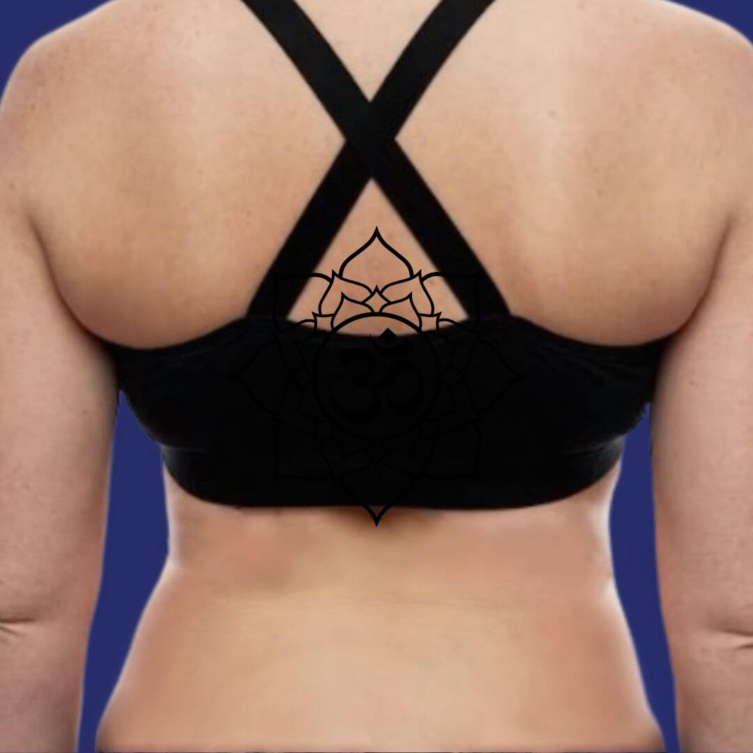  Photo after liposuction on back