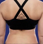 foto después liposucción espalda