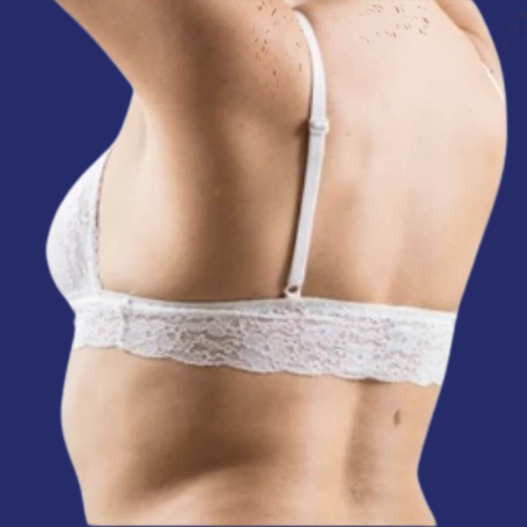 Liposuction before and after photo of back