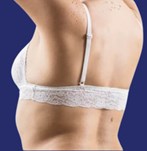 liposucción foto antes y después espalda