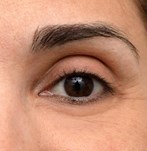 Imagen previa a la blefaroplastia
