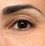 Imagen posterior a la blefaroplastia