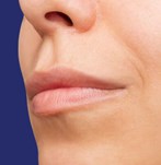 antes relleno de labios