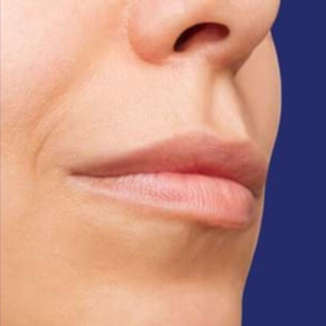 antes relleno de labios