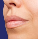después de un relleno de labios