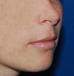relleno de labios antes