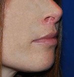relleno de labios después