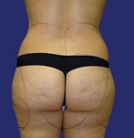 Before liposuction legs and buttocks
