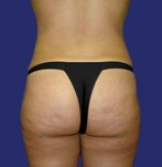 After Liposuction legs and buttocks