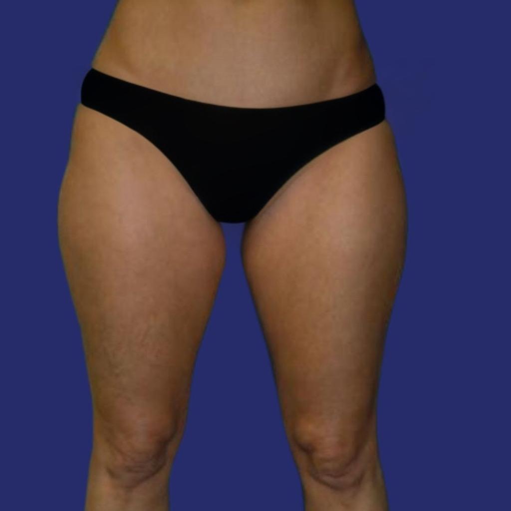 eliminate saddlebags and inner thighs 