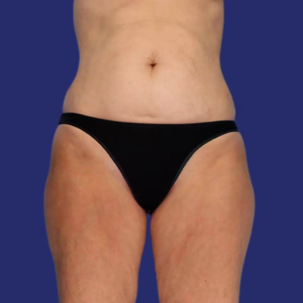 eliminate saddlebags liposuction
