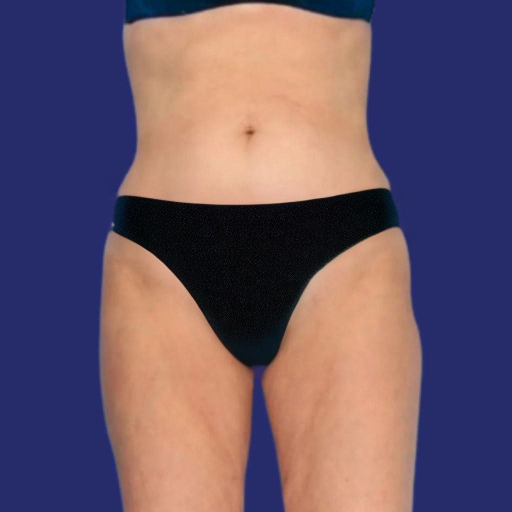 eliminate saddlebags liposuction before and after