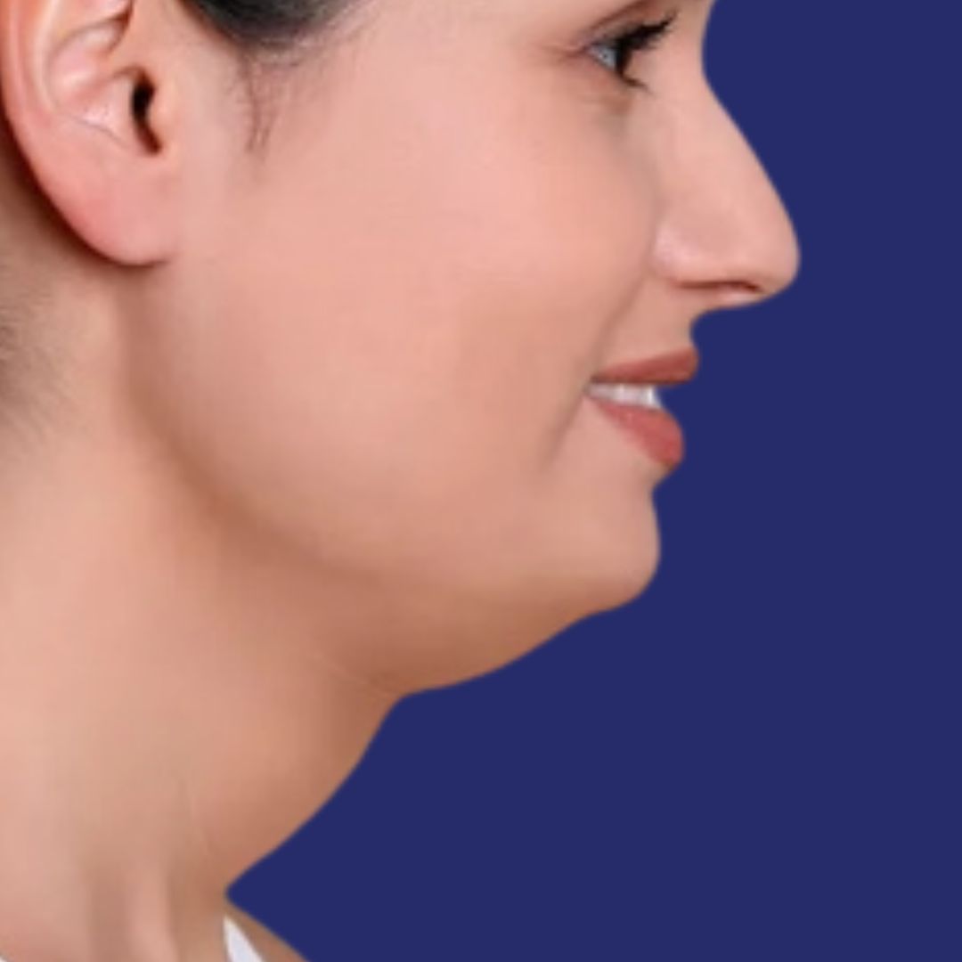 Foto antes de liposucción papada