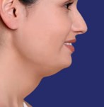 Foto antes de liposucción papada