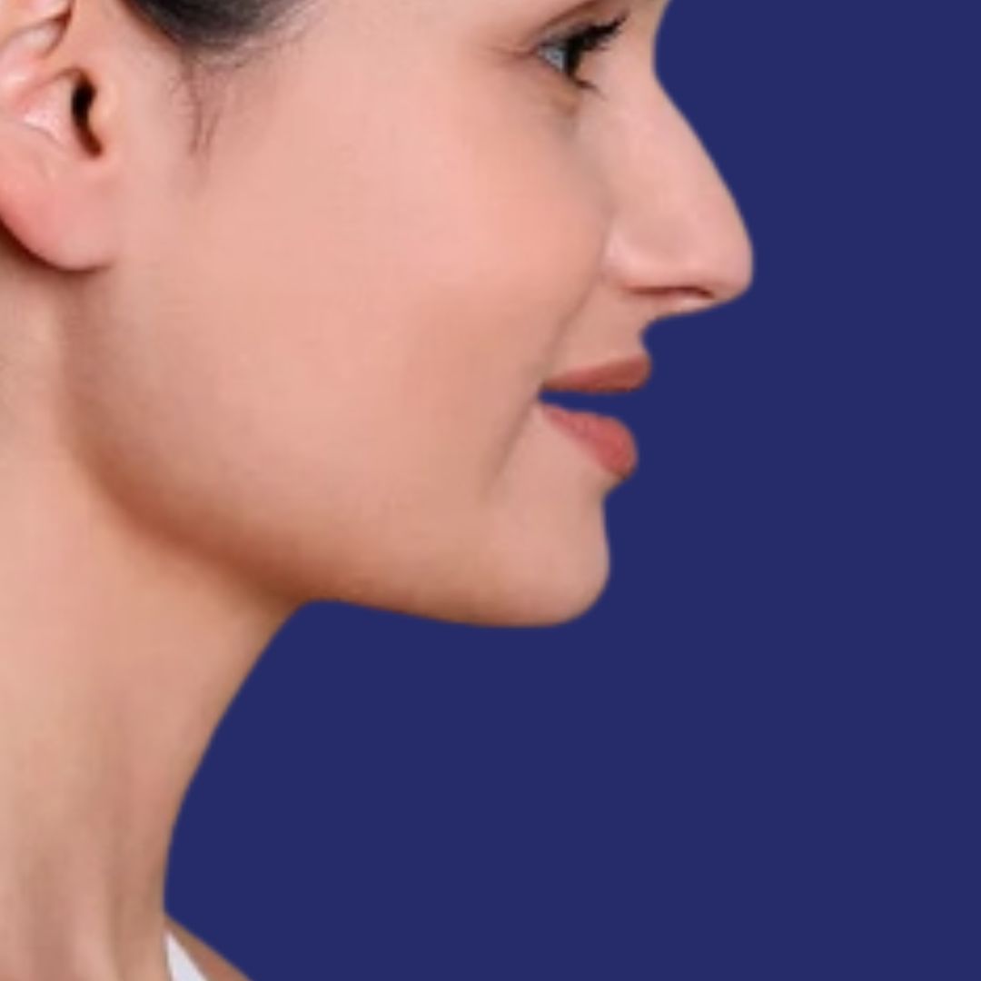 Fotografía resultados lipo papada