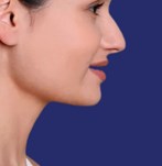 Fotografía resultados lipo papada