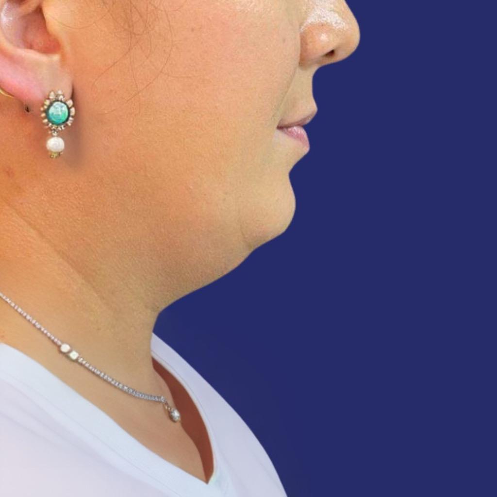 eliminar la papada con liposucción