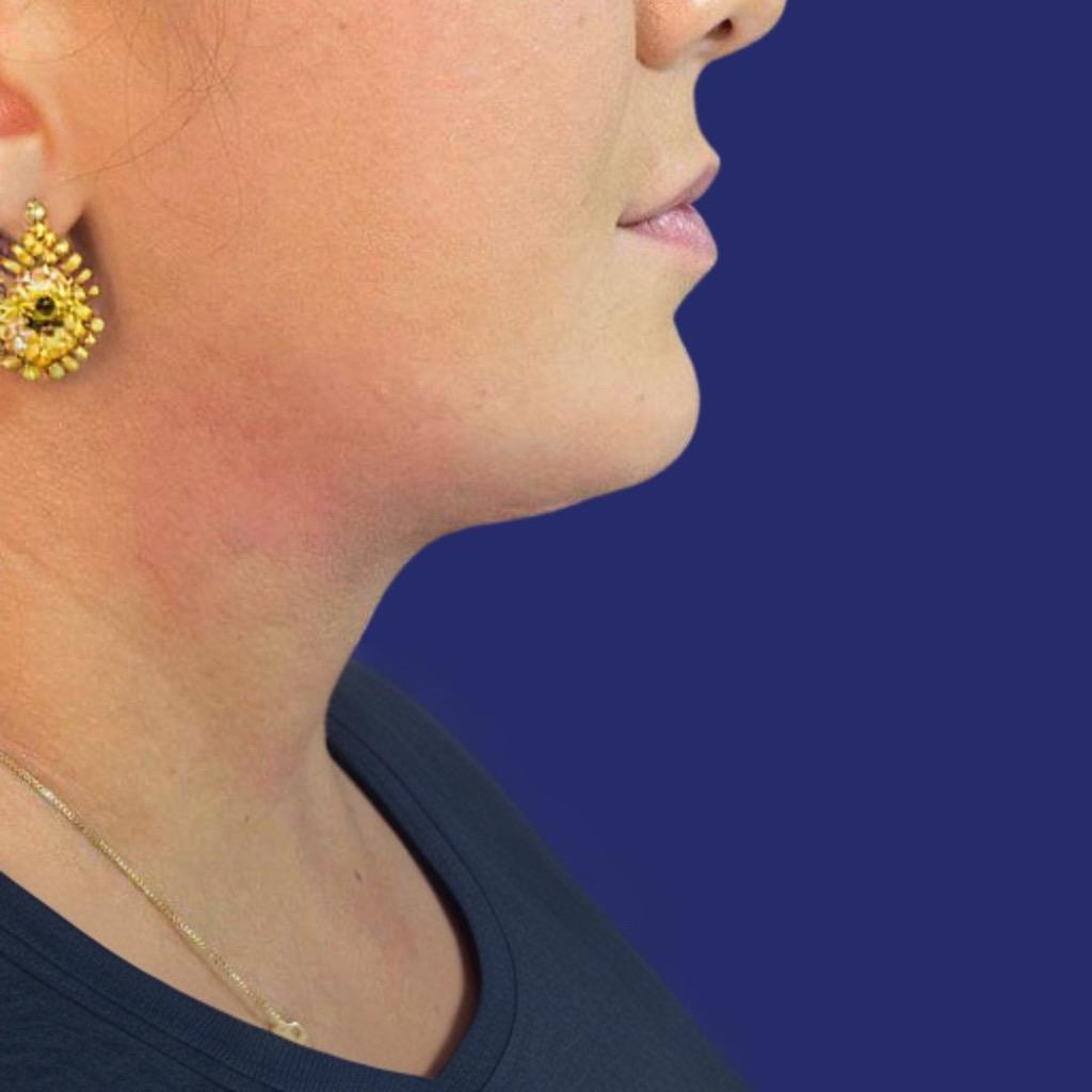 foto resultado eliminar papada pacientes reales