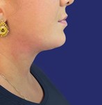 foto resultado eliminar papada pacientes reales