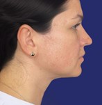 Lipo resultados naturales papada