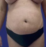 Liposucción combinada con abdominoplastia