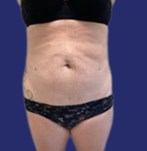 Liposucción combinada con abdominoplastia resultados