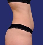 Liposucción abdomen