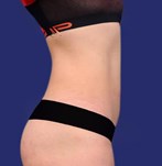 Abdomen plano resultados