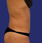 fotografía de un paciente real resultados después de liposucción en Barcelona