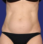 solución definitiva para eliminar la grasa rebelde