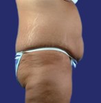 Side view of flabby abdomen before Fleur-de-Lis Tummy Tuck