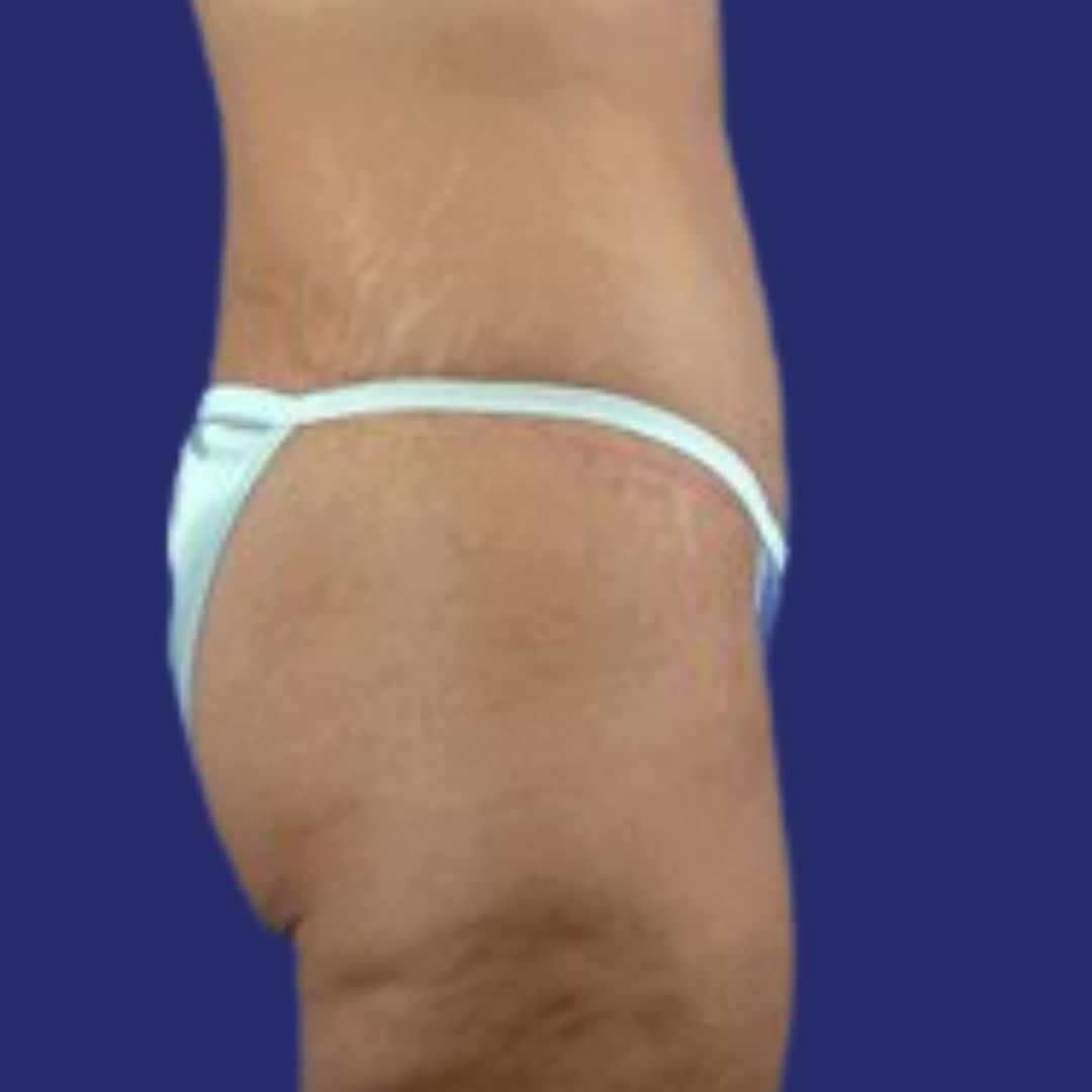 Vista lateral de abdomen definido después de abdominoplastia técnica flor de lis