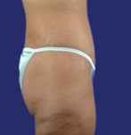 Side view of flabby abdomen before Fleur-de-Lis Tummy Tuck