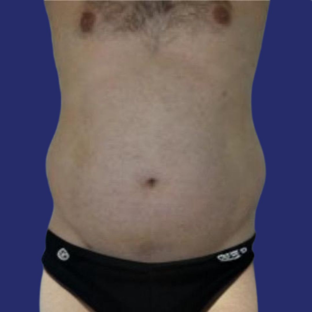 Paciente con abdomen prominente antes de cirugía de abdominoplastia