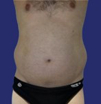 Patient with prominent abdomen before tummy tuck men surgery