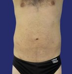 Patient with flat and toned abdomen after abdominoplasty surgery