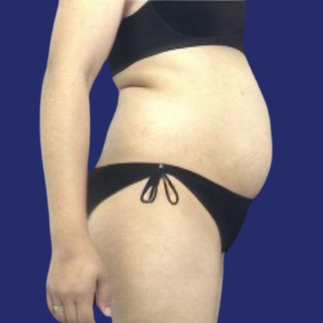 Abdomen antes de la cirugía de abdominoplastia