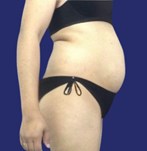 Abdomen before abdominoplasty surgery