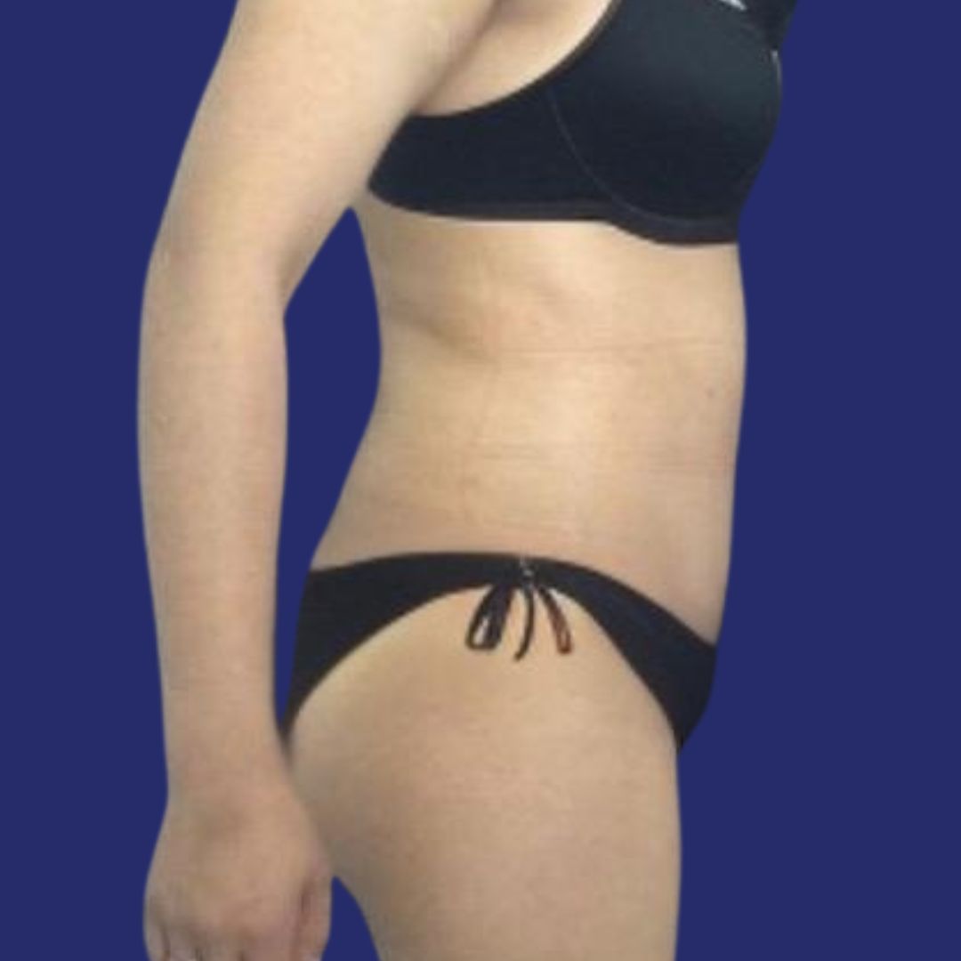 Piel abdominal plana tras abdominoplastia
