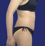 Flat abdominal skin after abdominoplasty