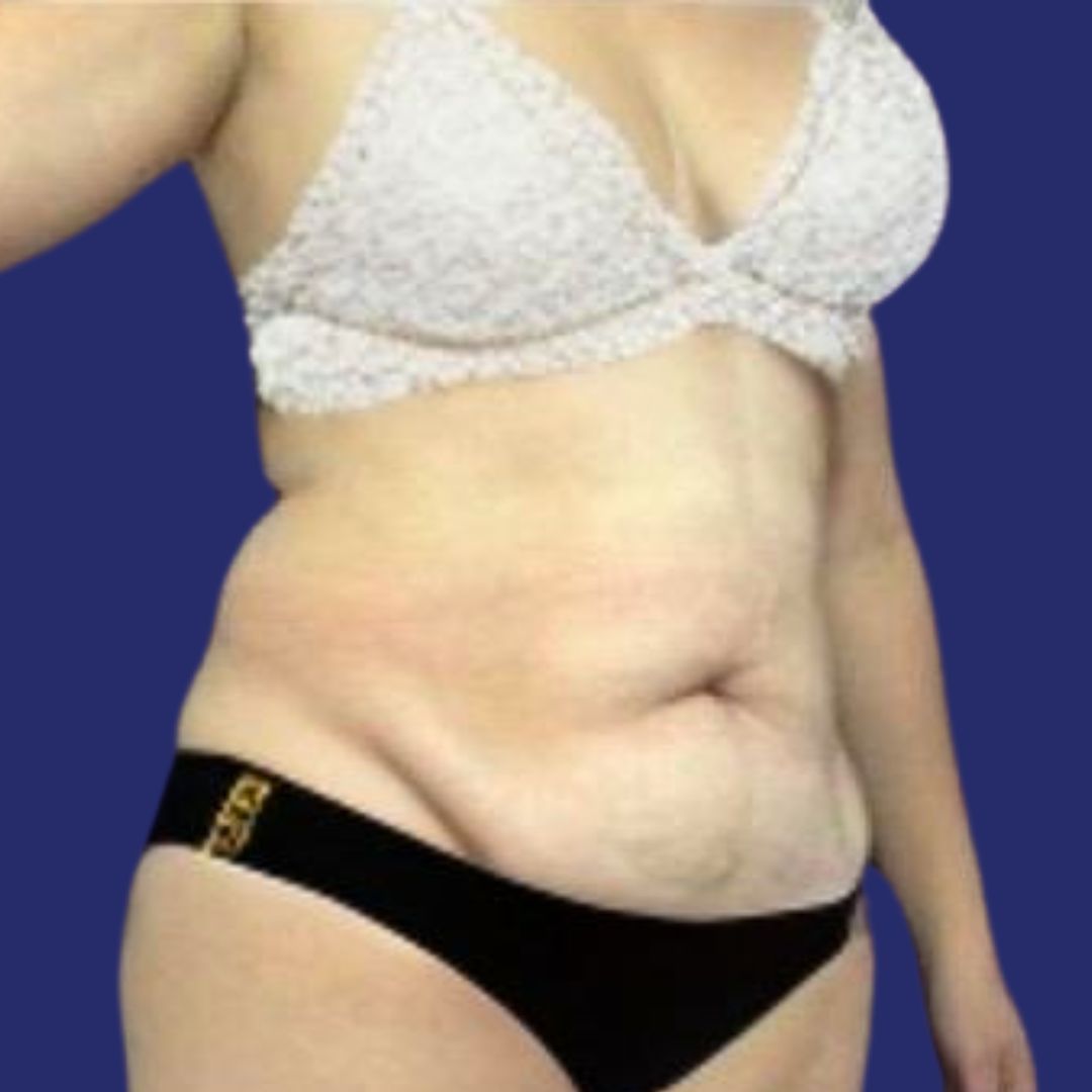 Paciente abdominoplastia correctiva piel colgante técnica 